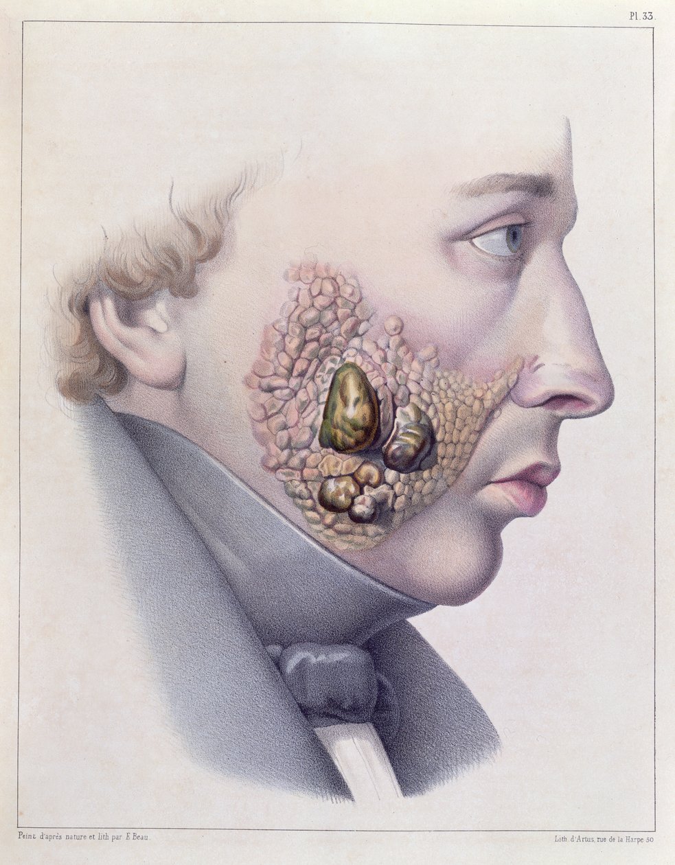 Sukupuolitaudin kasvojen oireet, Philippe Ricordin (1800-89) 1851 kirjoittamasta Traite Complet des Maladies Veneriennesistä tekijältä French School