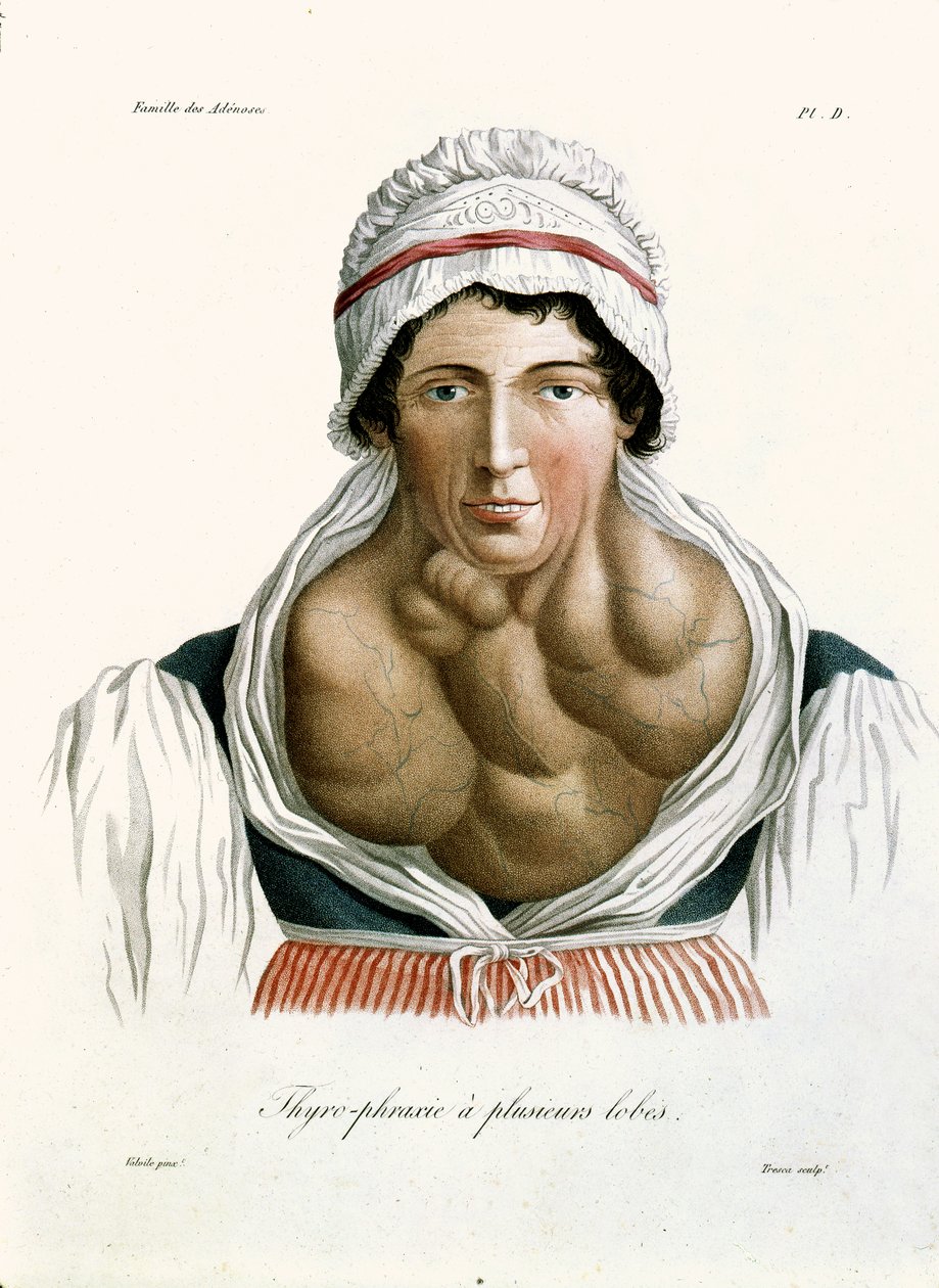 Kilpirauhasen sairaus, paroni Jean Louis Alibertin (1768-1837) kirjasta 1817 tekijältä French School