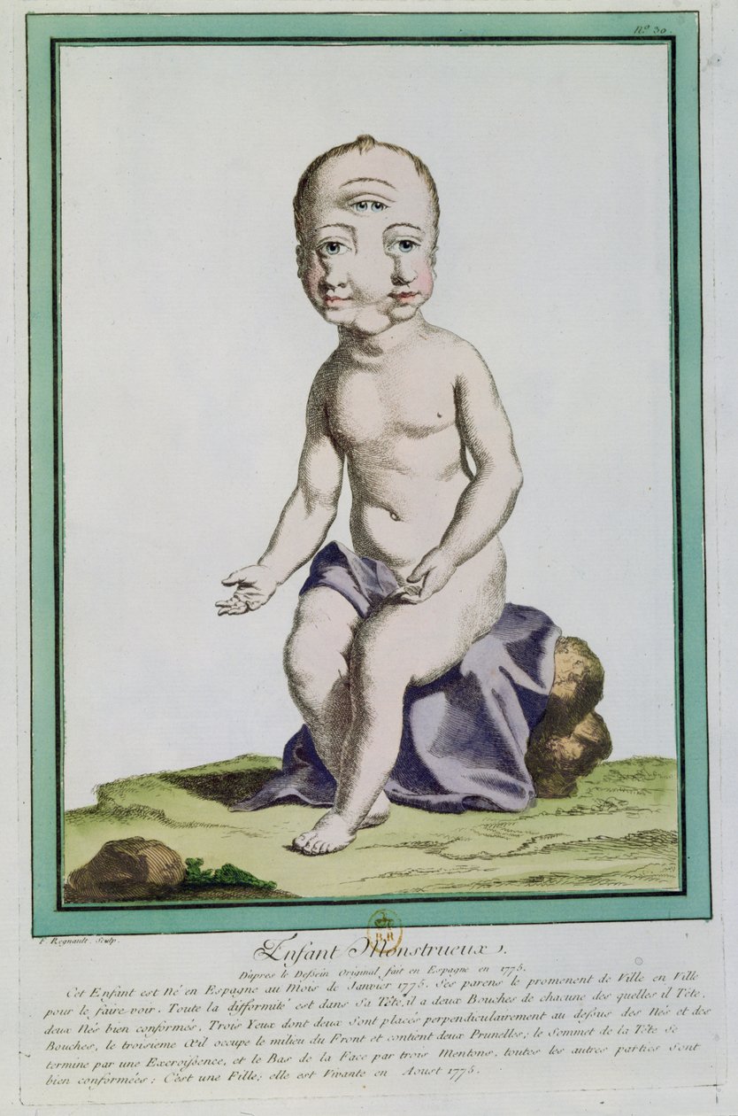 Lapsi, jolla on epämuodostunut pää, "Les Ecarts de la Nature", Pariisi, 1775 tekijältä Genevieve Regnault de Nangis