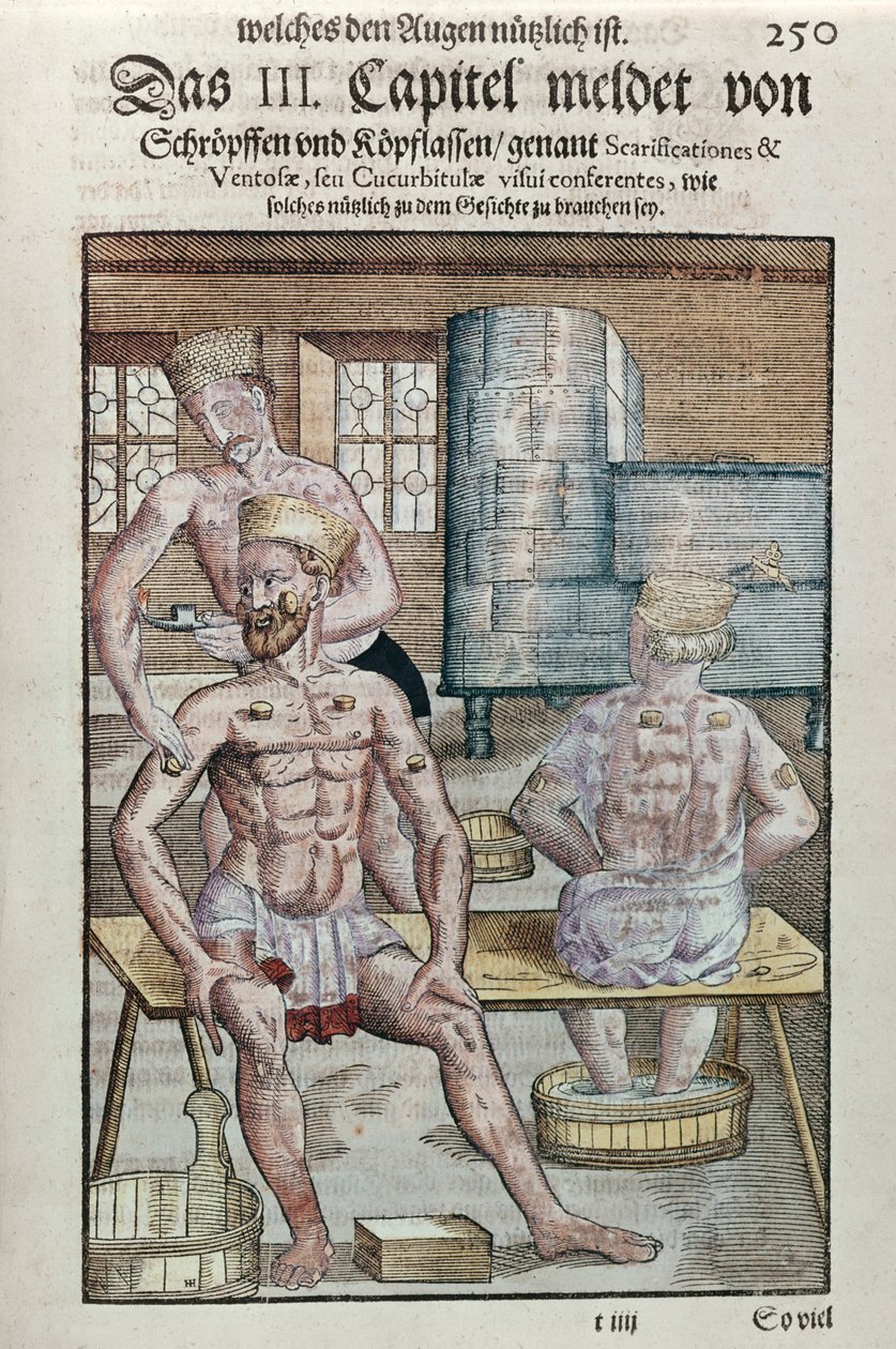 Kuppaus, Georg Bartischin (1535-1636) Ophthalmodouleiasta, joka julkaistiin Dresdenissä vuonna 1583 (värillinen puupainatus) tekijältä German School