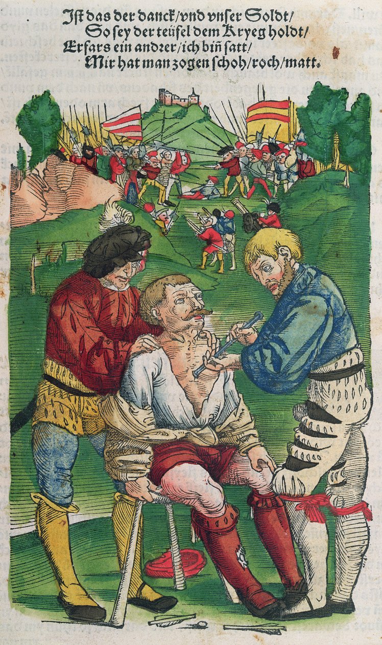 Nuolen poistaminen, Hans von Gersdorffin kuvitus Feldtbuch der Wundartzneysta, 1540 tekijältä German School