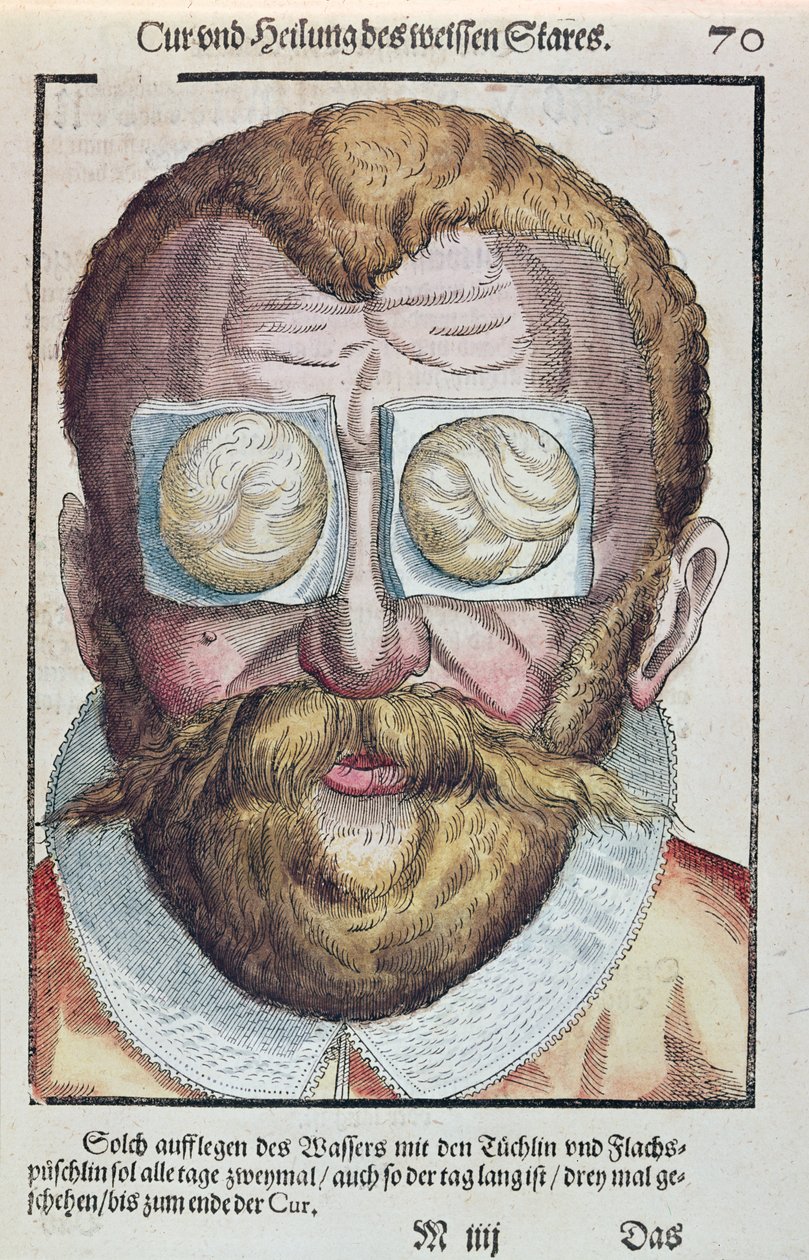 Silmäsairauden hoito, Georg Bartischin (1535-1636) Ophthalmodouleiasta, joka julkaistiin Dresdenissä vuonna 1583 (värillinen puupainatus) tekijältä German School