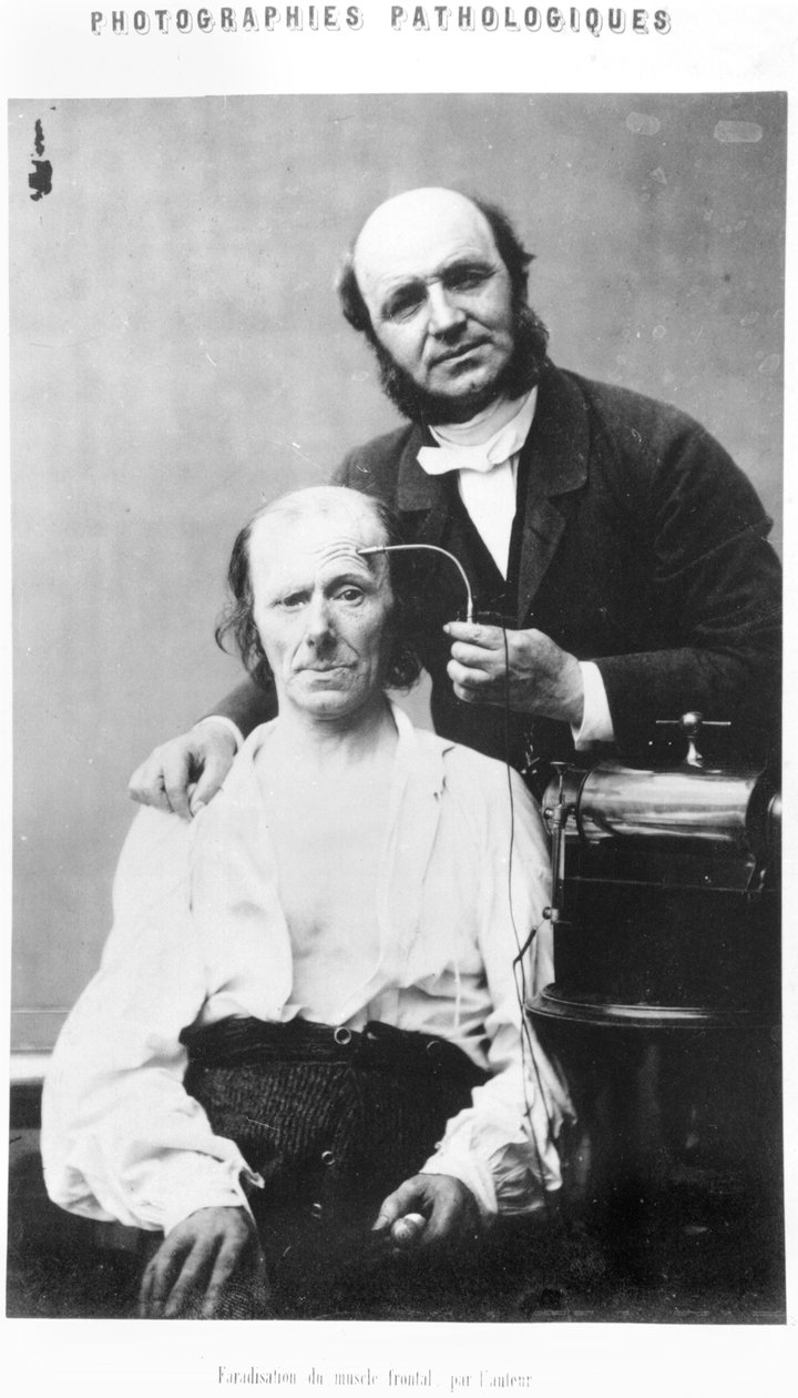 Frontaalilihaksen faradisaatio, Duchenne de Boulognen Album de photographies pathologiques, julkaistu 1862, Pariisi tekijältä Guillaume Benjamin Armand Duchenne de Boulogne