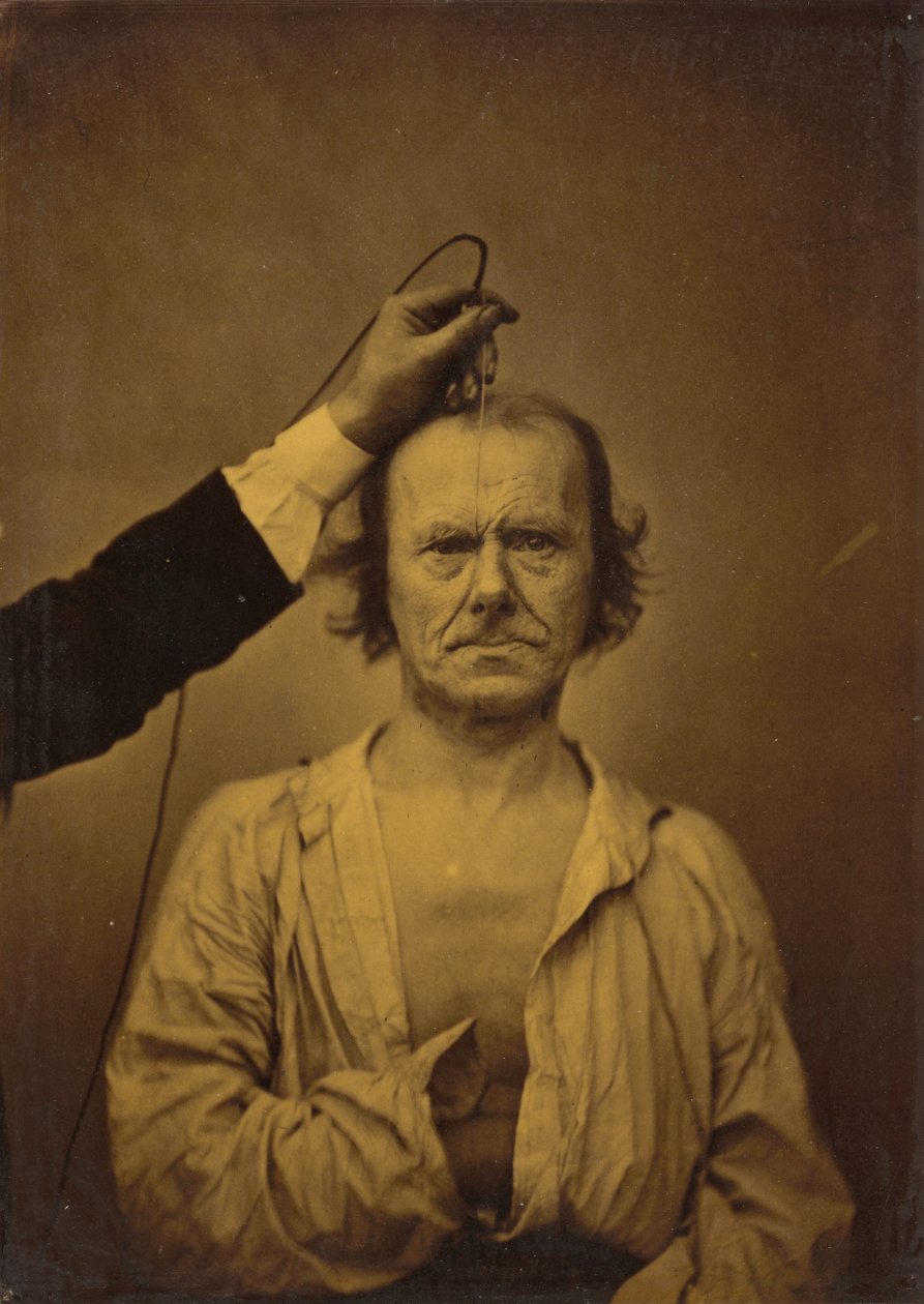 Huomio (vasemmalla); vakavuus, aggressio (oikealla),1854-1856, painettu 1862 (kuva). tekijältä Guillaume Benjamin Armand Duchenne de Boulogne