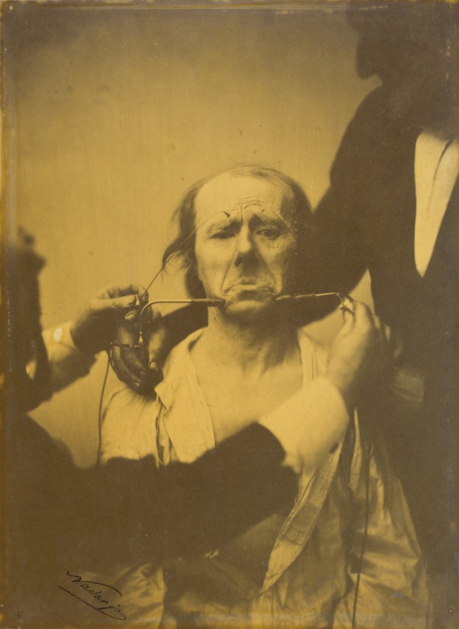 Tuskaa ja epätoivoa,1854-1856, painettu 1862 (kuva). tekijältä Guillaume Benjamin Armand Duchenne de Boulogne