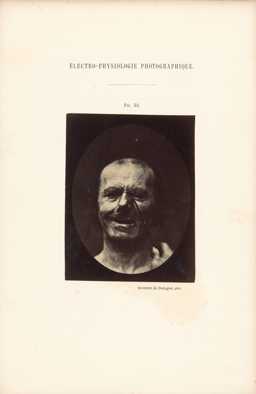 Valokuvasähköfysiologia, kuva 53. tekijältä Guillaume Benjamin Duchenne