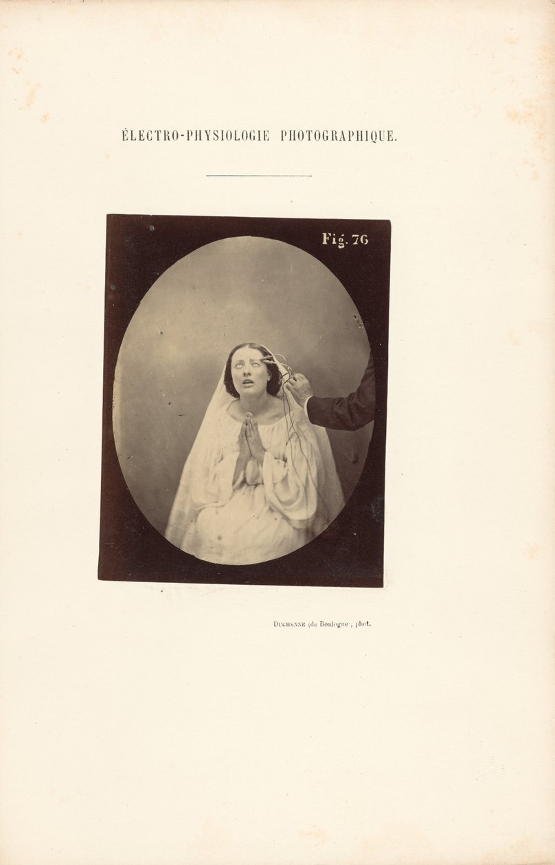Valokuvasähköfysiologia, kuva 76 tekijältä Guillaume Benjamin Duchenne