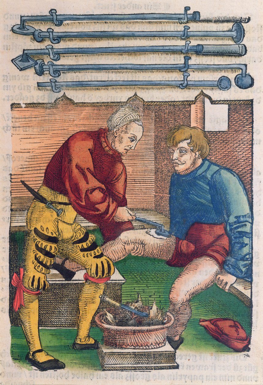 Kauterisointi, kuvitus Hans von Gersdorffin teoksesta "Feldtbuch der Wundartzney", n. 1540 (värillinen puupainatus) tekijältä Hans or Johannes Ulrich Wechtlin