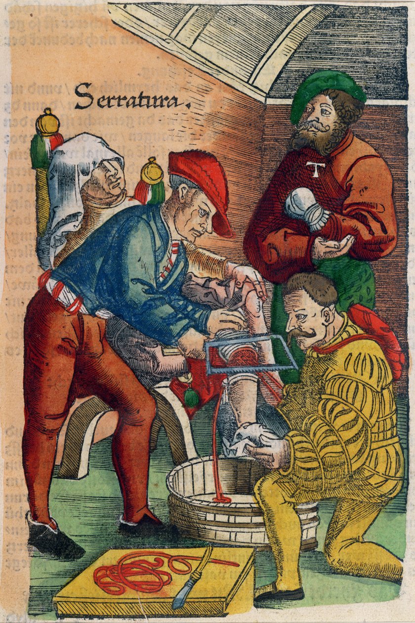 Amputaatio, kuvitus Hans von Gersdorffin teoksesta "Feldtbuch der Wundartzney", n. 1540 (värillinen puupainatus) tekijältä Hans or Johannes Ulrich Wechtlin
