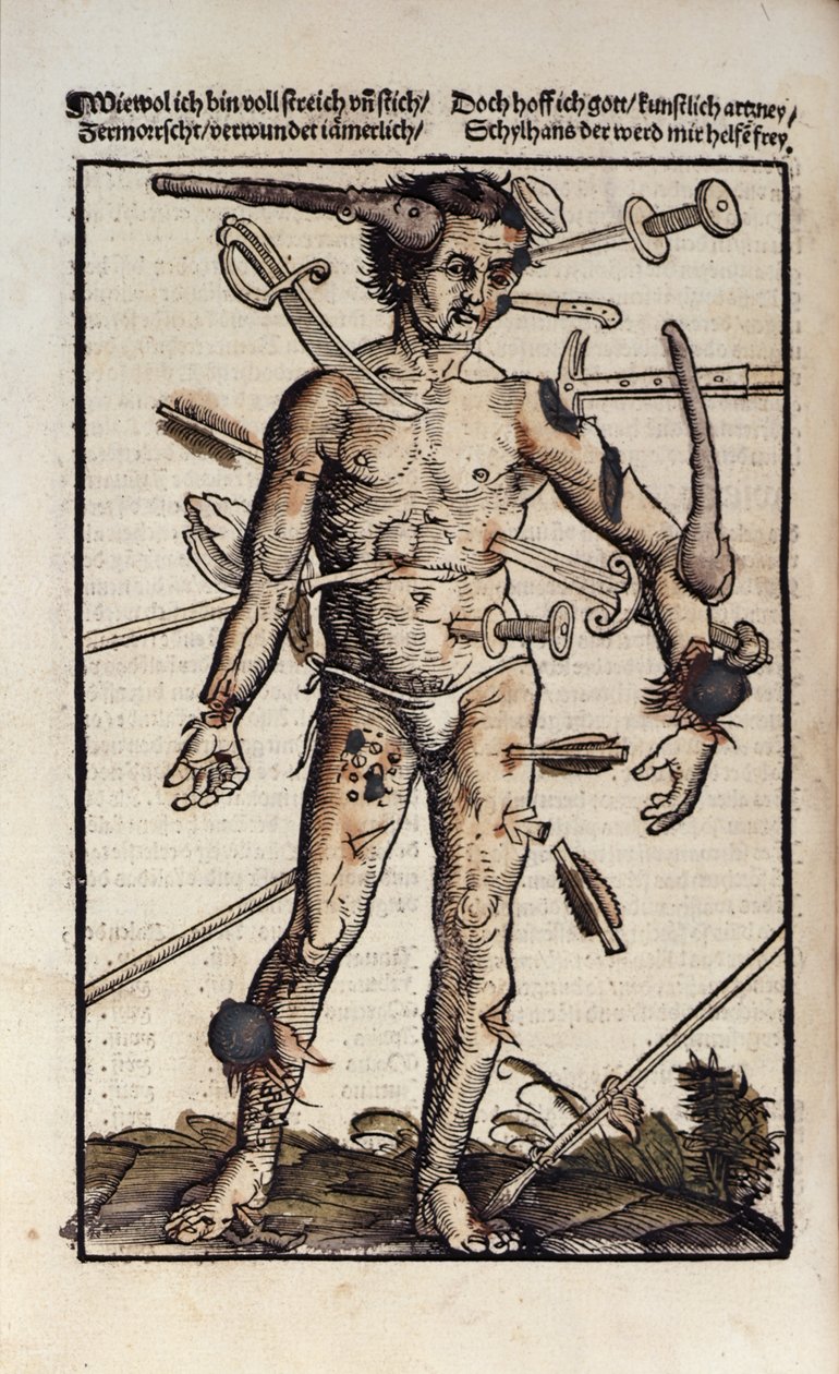 XVIIIv Haavamies, Hans von Gersdorffin Feldtbuch der Wundartzneysta tekijältä Hans or Johannes Ulrich Wechtlin