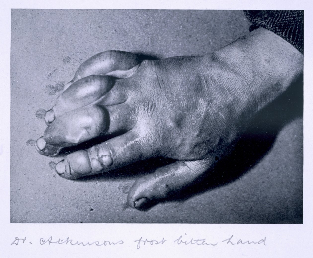 Tohtori Atkinsonin pakkanen purema käsi, 1911 tekijältä Herbert Ponting