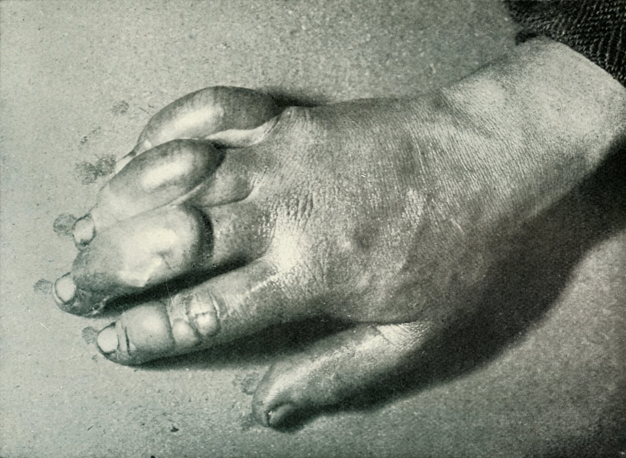 Dr. Atkinsons Frost-Bitten Hand, 5. heinäkuuta 1911, 1913 tekijältä Herbert Ponting