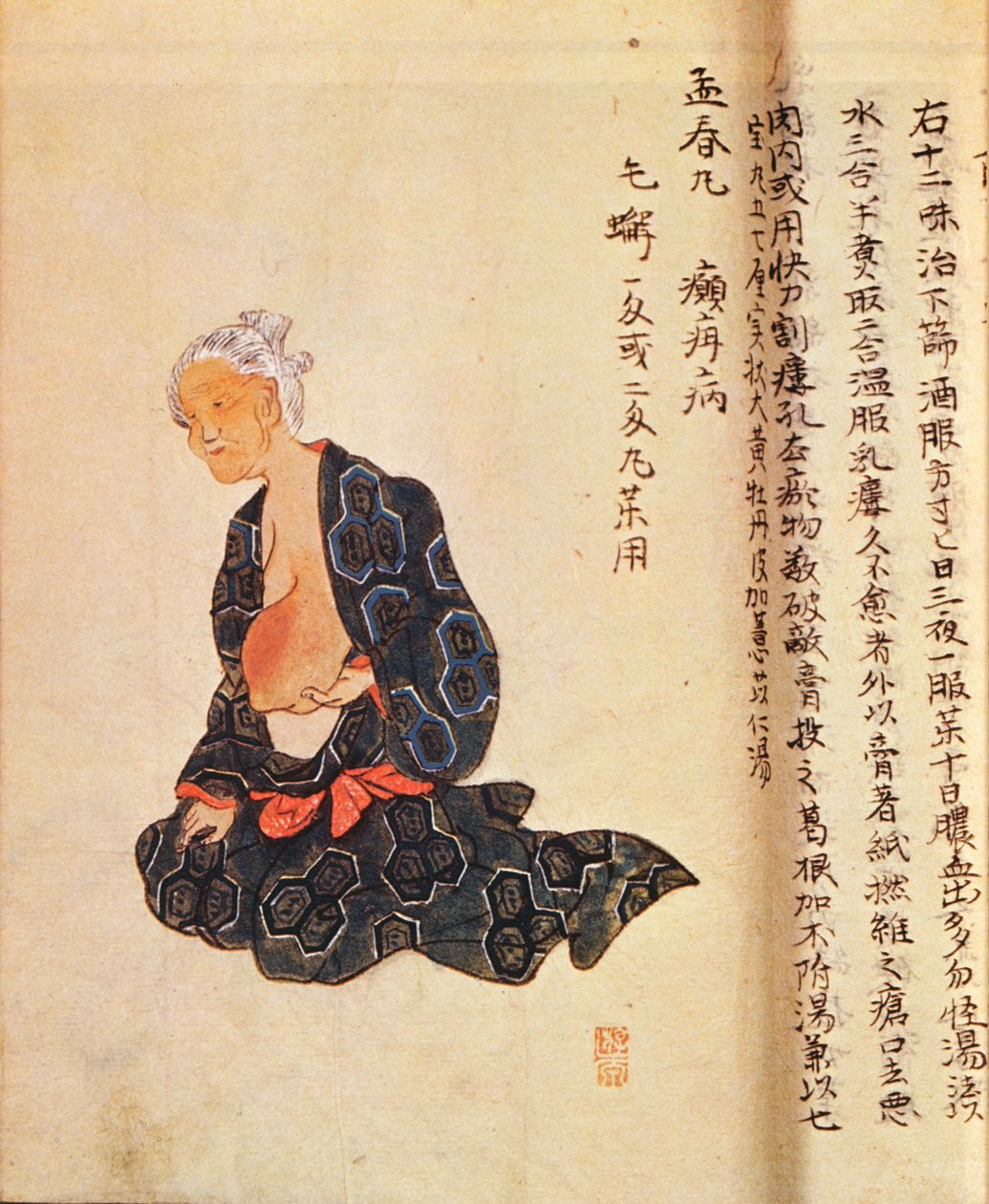 Ensimmäinen rintasyövän kirurginen hoito, jonka suoritti Seishu Hanaoka (1760-1836) yleisanestesiassa vuonna 1804 tekijältä Japanese School