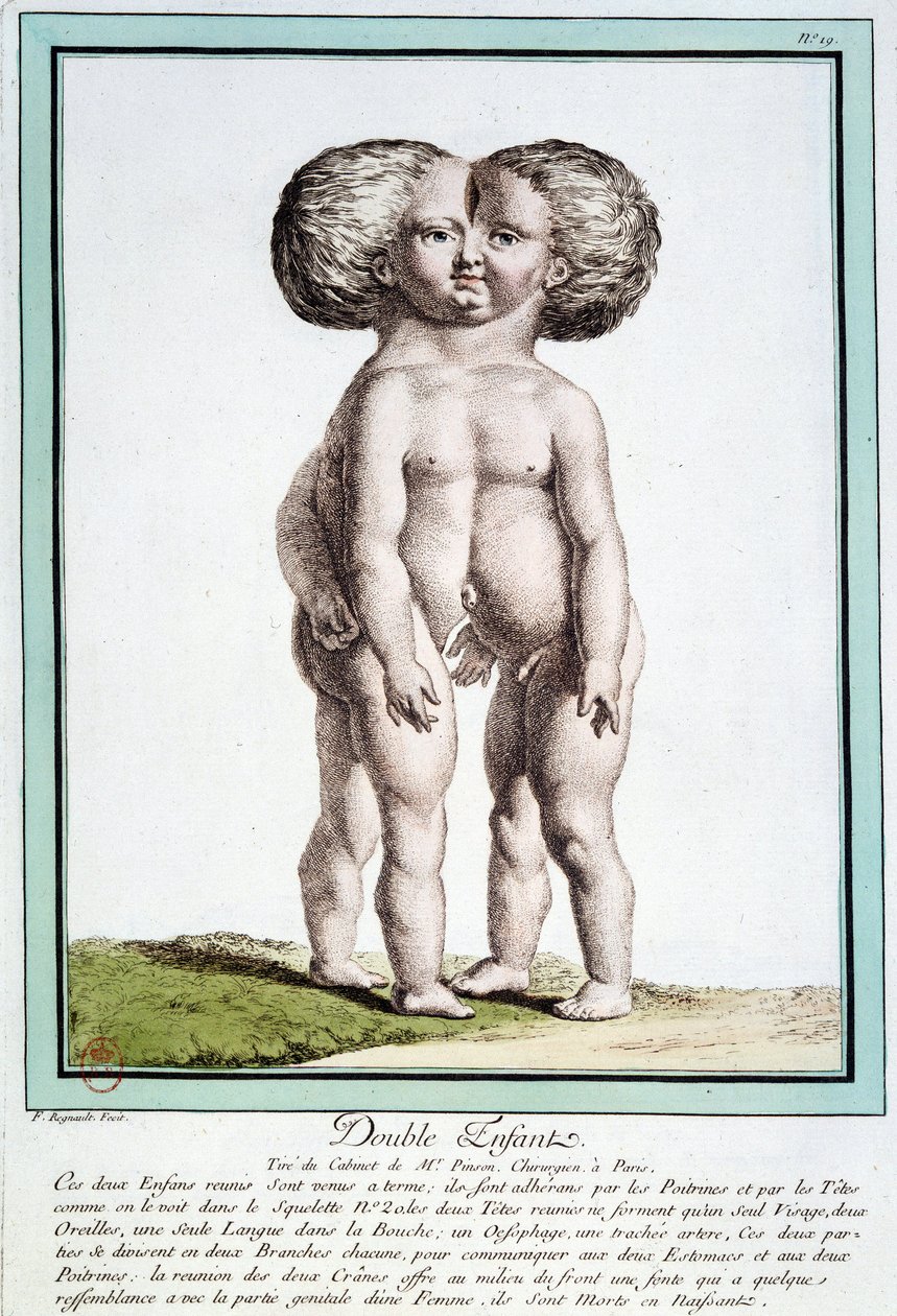 Siamilaiset lapset - Régnaultin "" Luonnon poikkeamat" -osassa tekijältä Jean Baptiste Regnault