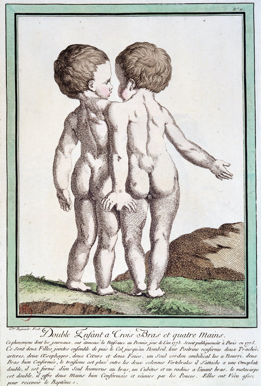 Siamilaiset lapset - Régnaultin "" Luonnon poikkeamat" -osassa tekijältä Jean Baptiste Regnault
