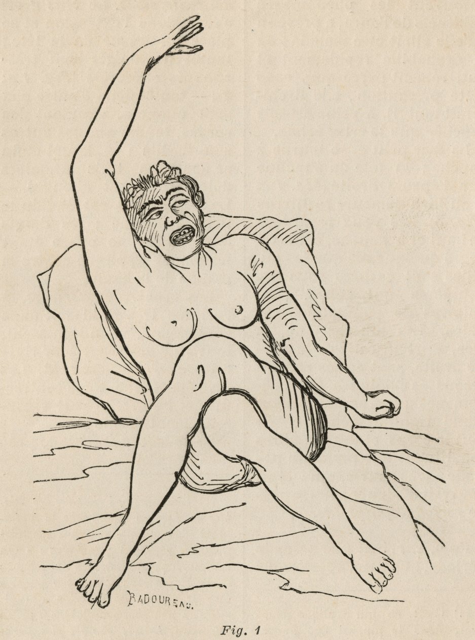 Hysteerinen epilepsia, kohtaus, vääntymät, kuva. 1 teoksesta "Iconographie Photographique de La Salpetriere", Bourneville et P. Regnard, Pariisi, 1876 tekijältä Jean Francois Badoureau