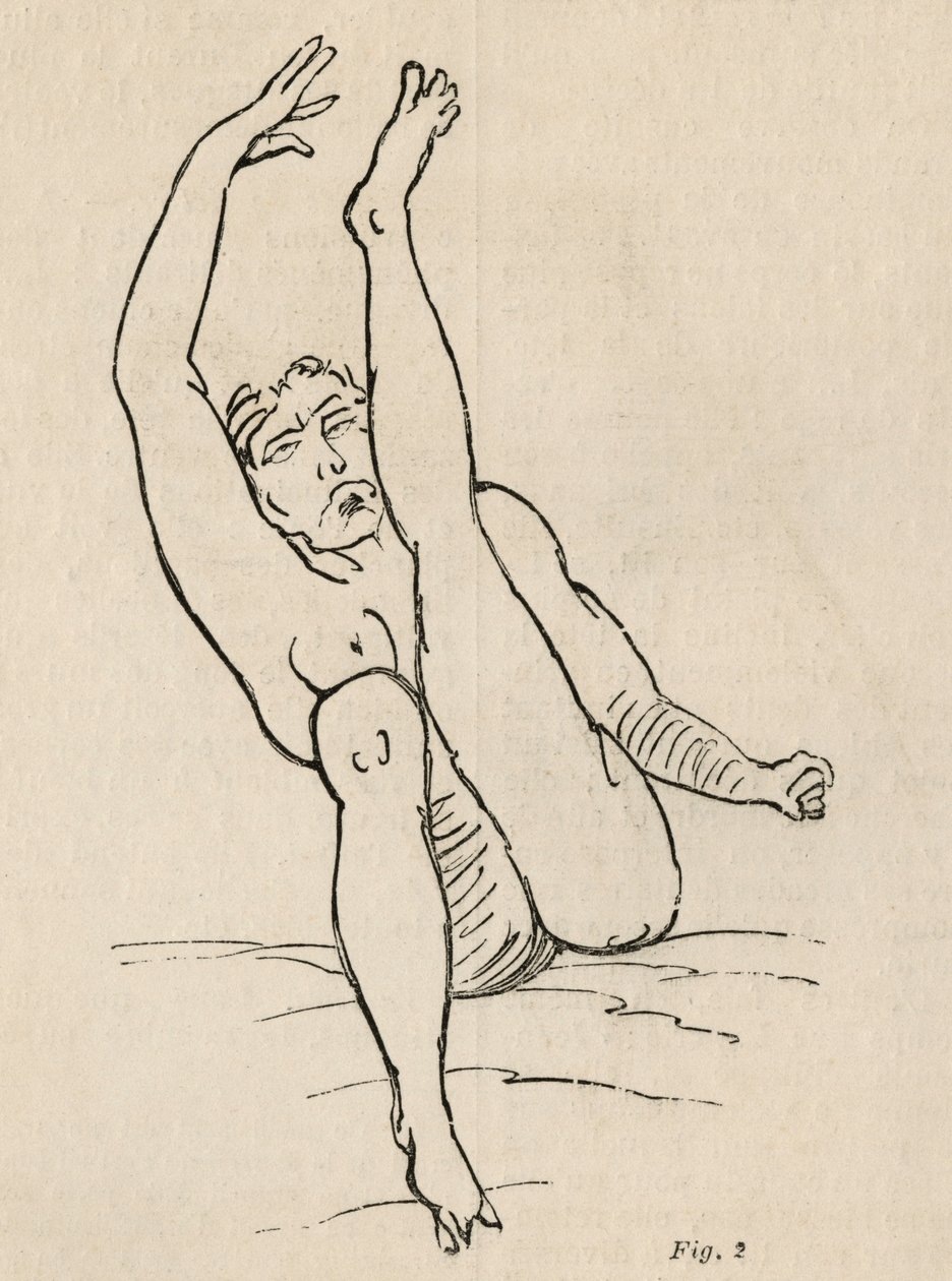 Hysteerinen epilepsia, kohtaus, kouristukset, kuva 2 Bourneville et P.:n "Iconographie Photographique de La Salpetriere" -teoksesta. Regnard, Pariisi, 1876 tekijältä Jean Francois Badoureau