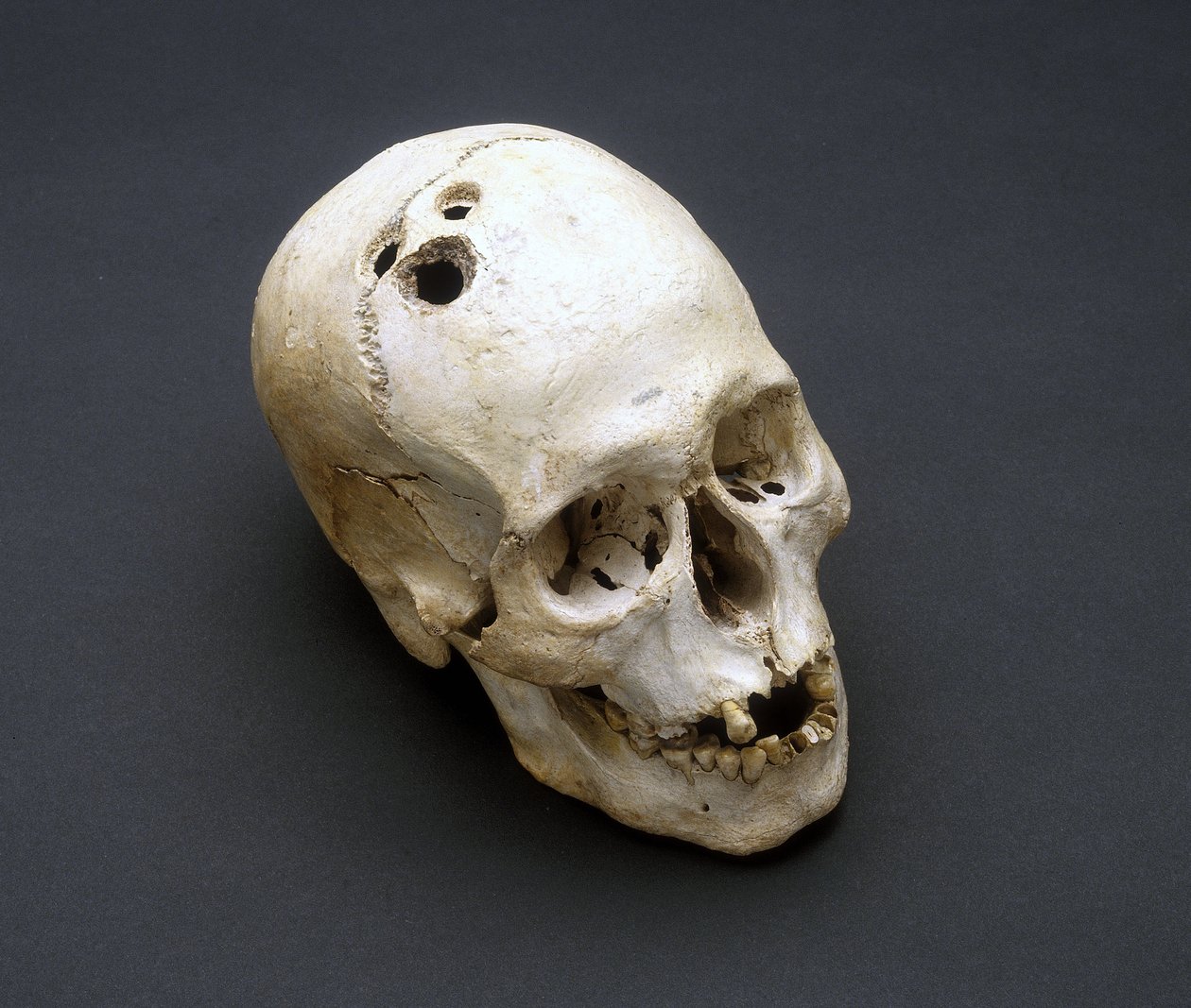 Trephination pronssikauden kallo, Jericho, Palestiina, 2200-2000 eaa. tekijältä Unbekannt Unbekannt