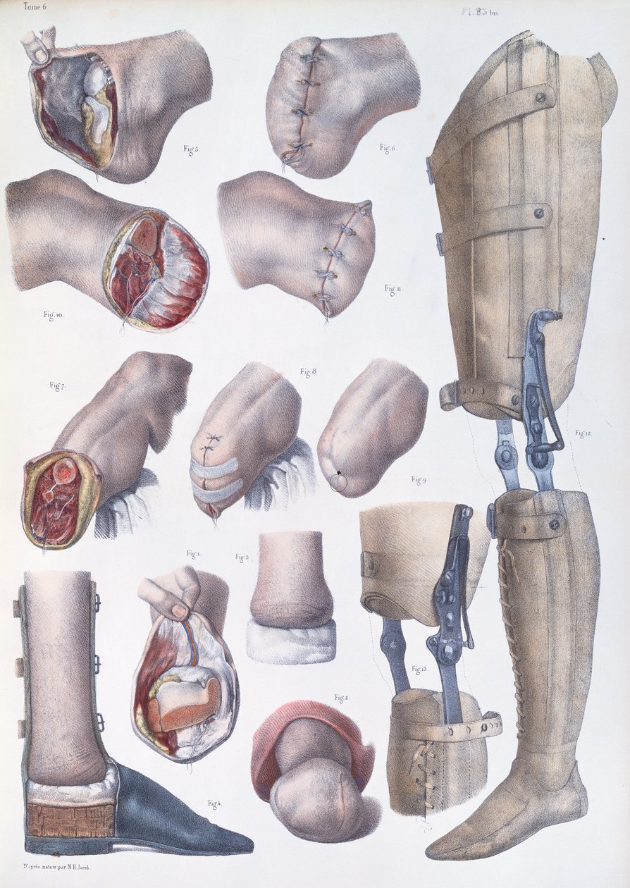 Amputaatiot ja proteesit, levy Jean-Baptiste Marc Bourgeryn (1797-1849) "Traite Complet de l