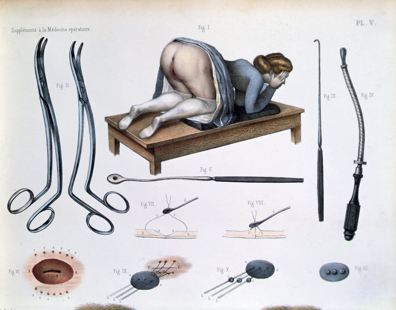 Vesikovaginaalisen fistelin leikkaus, levy Jean-Baptiste Marc Bourgeryn (1797-1849) teoksesta "Traite Complet de l