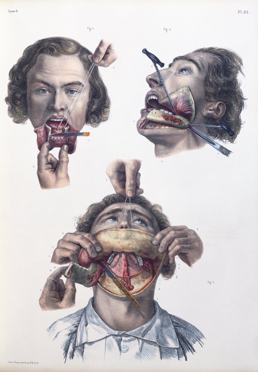 Leikkaus alaleuassa, levy Jean-Baptiste Marc Bourgeryn (1797-1849) "Traite Complet de l