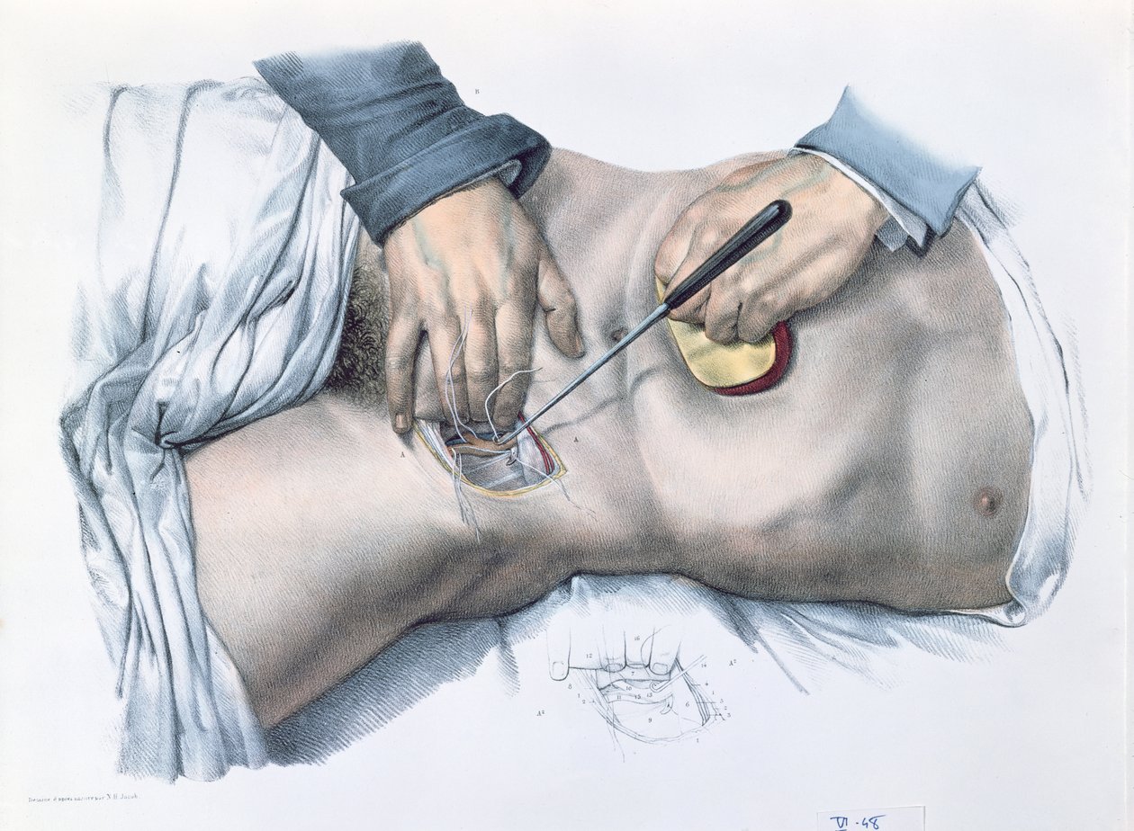 Valtimon sitominen, Jean-Baptiste Marc Bourgeryn (1797-1849) 1866-67 Traite Complet de l