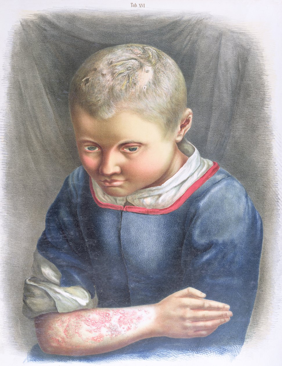 Favus, Daniel Cornelius Danielssenin (1815-94) kirjasta 1892 tekijältä Norwegian School