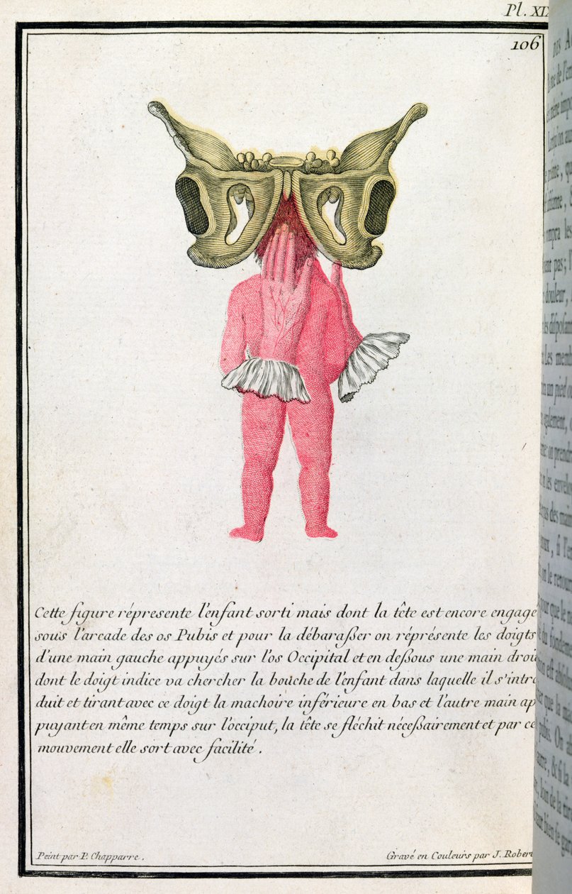 Poikkileikkauskaavio kohdusta vedetystä vauvasta, Madame Angelique Le Boursier du Coudrayn (1714-94) kirjasta, jonka kaiverrus on J. Robert, 1783 tekijältä P. Chapparre