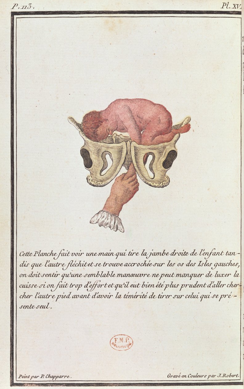Poikkileikkauskaavio vauvasta, joka on vedetty kohdusta käsivarresta, J. Robertin kaivertamasta Madame Angelique Le Boursier du Coudrayn (1714-94) kirjasta, 1783 tekijältä P. Chapparre