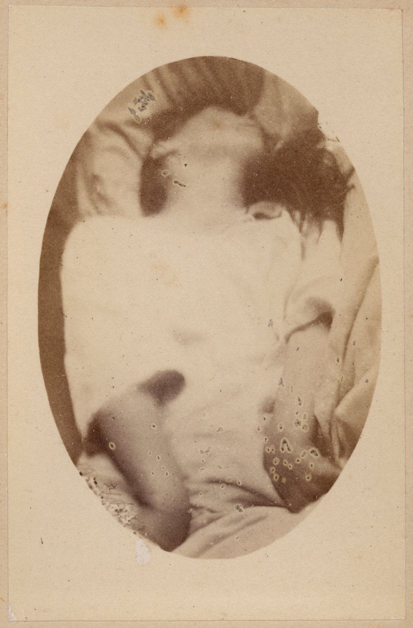 Hysteerinen epilepsia, kohtaus, epileptoidinen vaihe, kuva Bourneville et P:n julkaisemasta "Iconographie Photographique de La Salpetriere". Regnard, levy XVII, Pariisi, 1876 (valkopainatus). tekijältä Paul Regnard