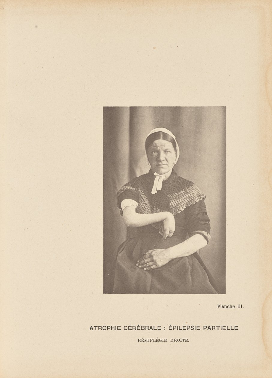Aivojen surkastuminen: Hemiplegia oikealla. tekijältä Paul Marie Léon Regnard