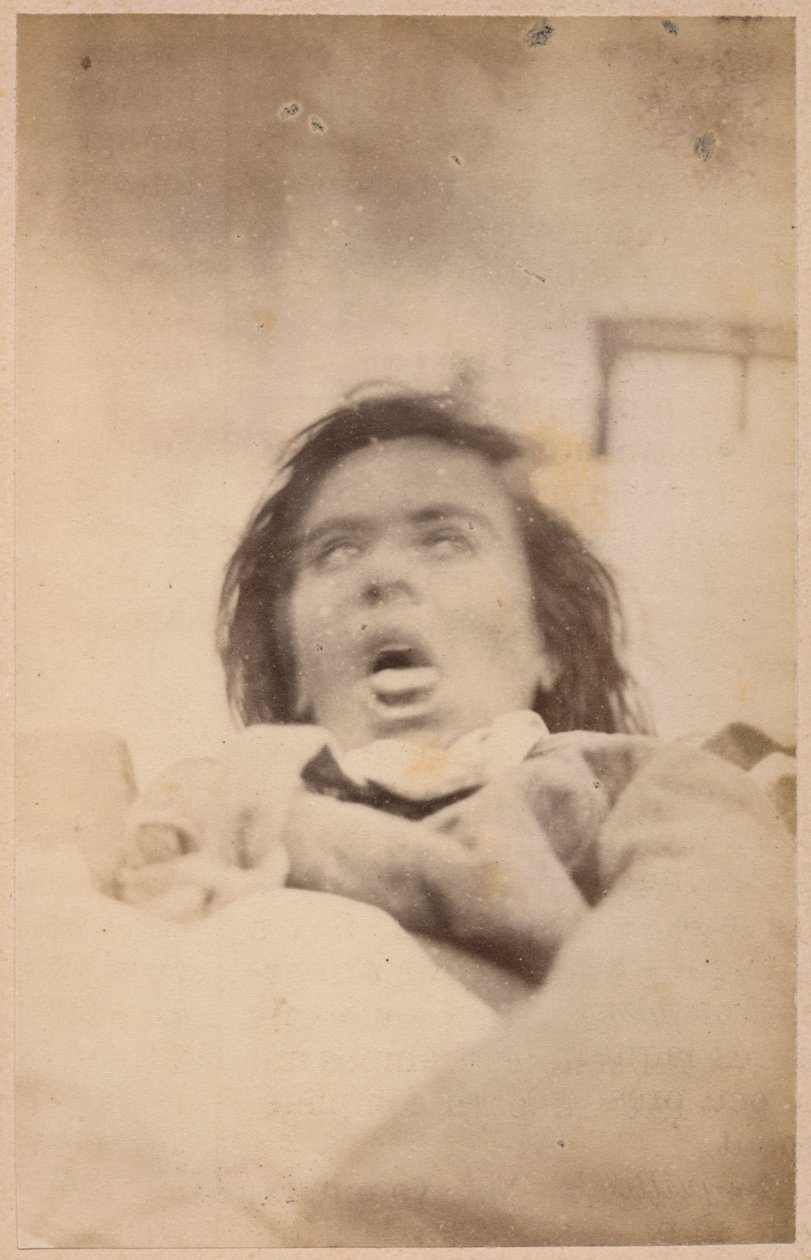 Hysteerinen epilepsia, hallusinaatiot, ahdistus, levy XXIX Bournevillen ja P. Regnardin teoksesta "Iconographie Photographique de La Salpetriere", Pariisi, 1876 (albumiprintti) tekijältä Paul Regnard