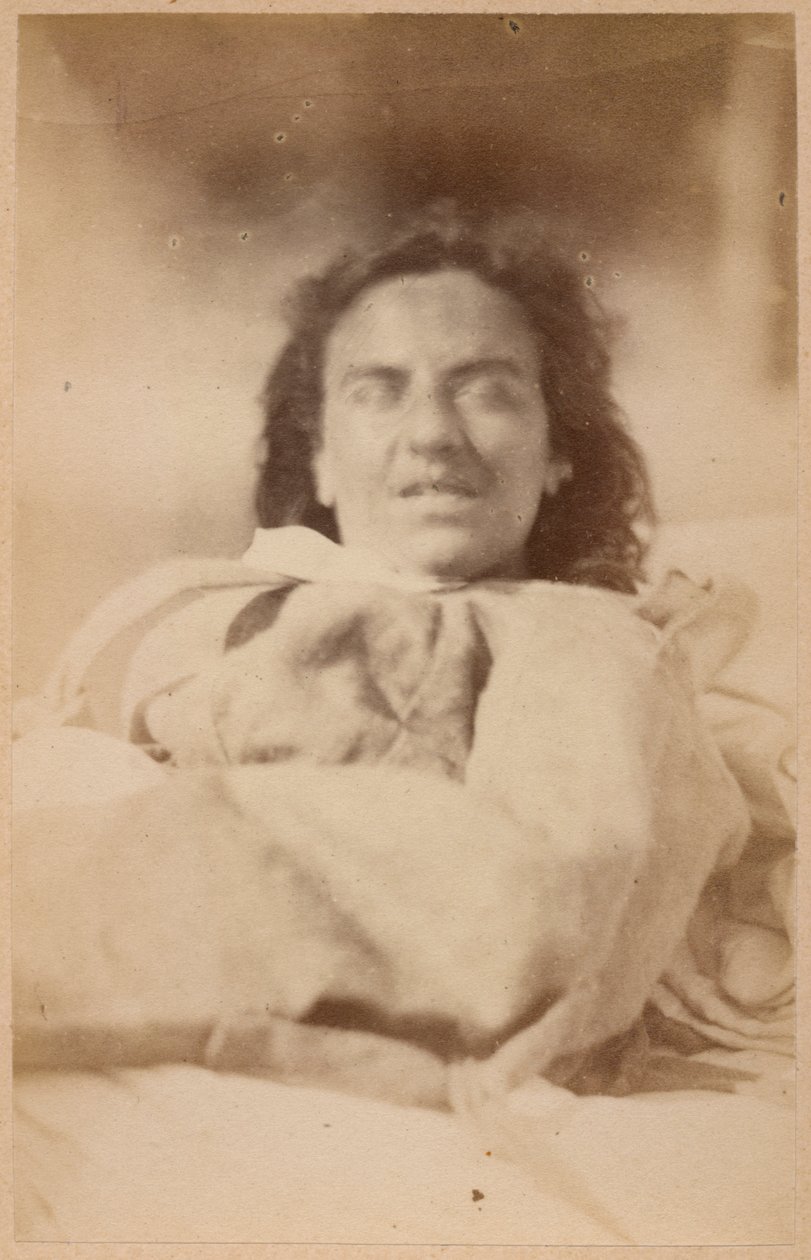 Hysteerinen epilepsia, hallusinaatiot, ironia, levy XXXII Bournevillen ja P. Regnardin teoksesta Iconographie Photographique de La Salpetriere, Pariisi, 1876 (albumiprintti) tekijältä Paul Regnard