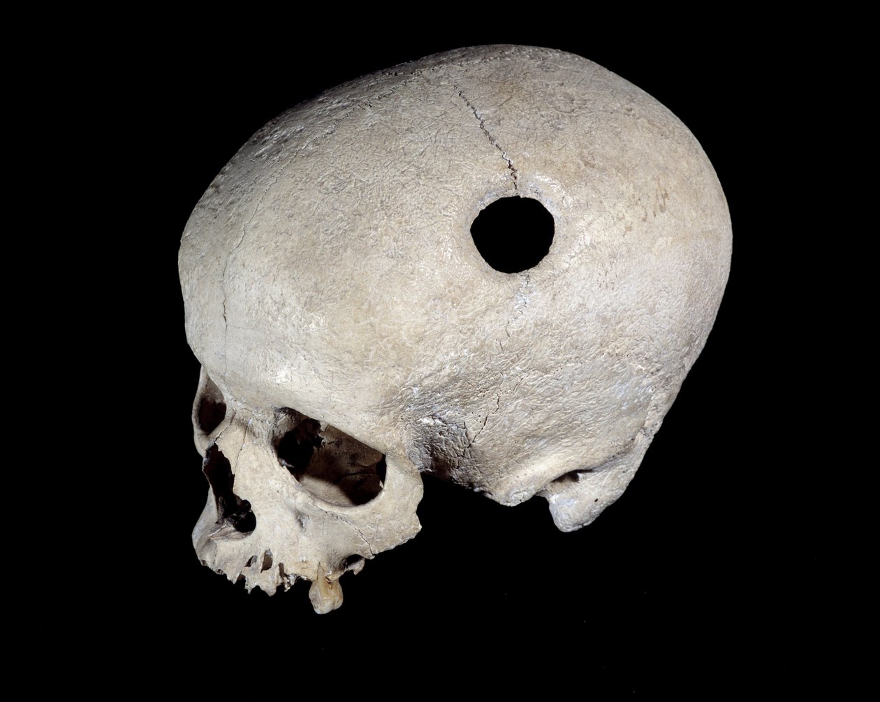 Esihistoriallinen kallo, jossa on trepanaatiojälki, National Antiquities Museum. tekijältä Prehistoric Prehistoric