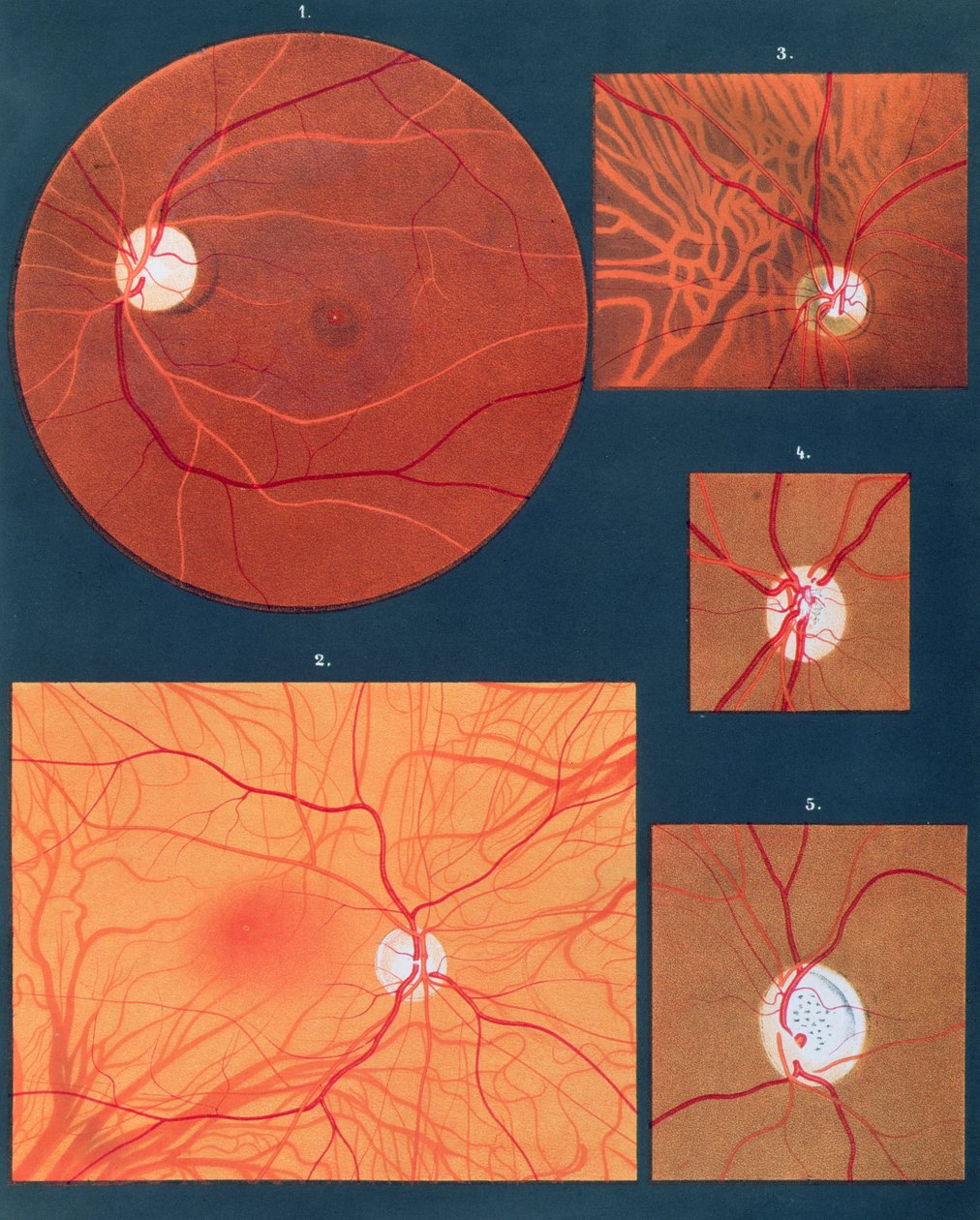 Silmä nähtynä mikroskoopilla, Atlas of Ophthalmoscopy, julkaistu Pariisissa, 1870 (chromolitho) tekijältä Richard Liebreich