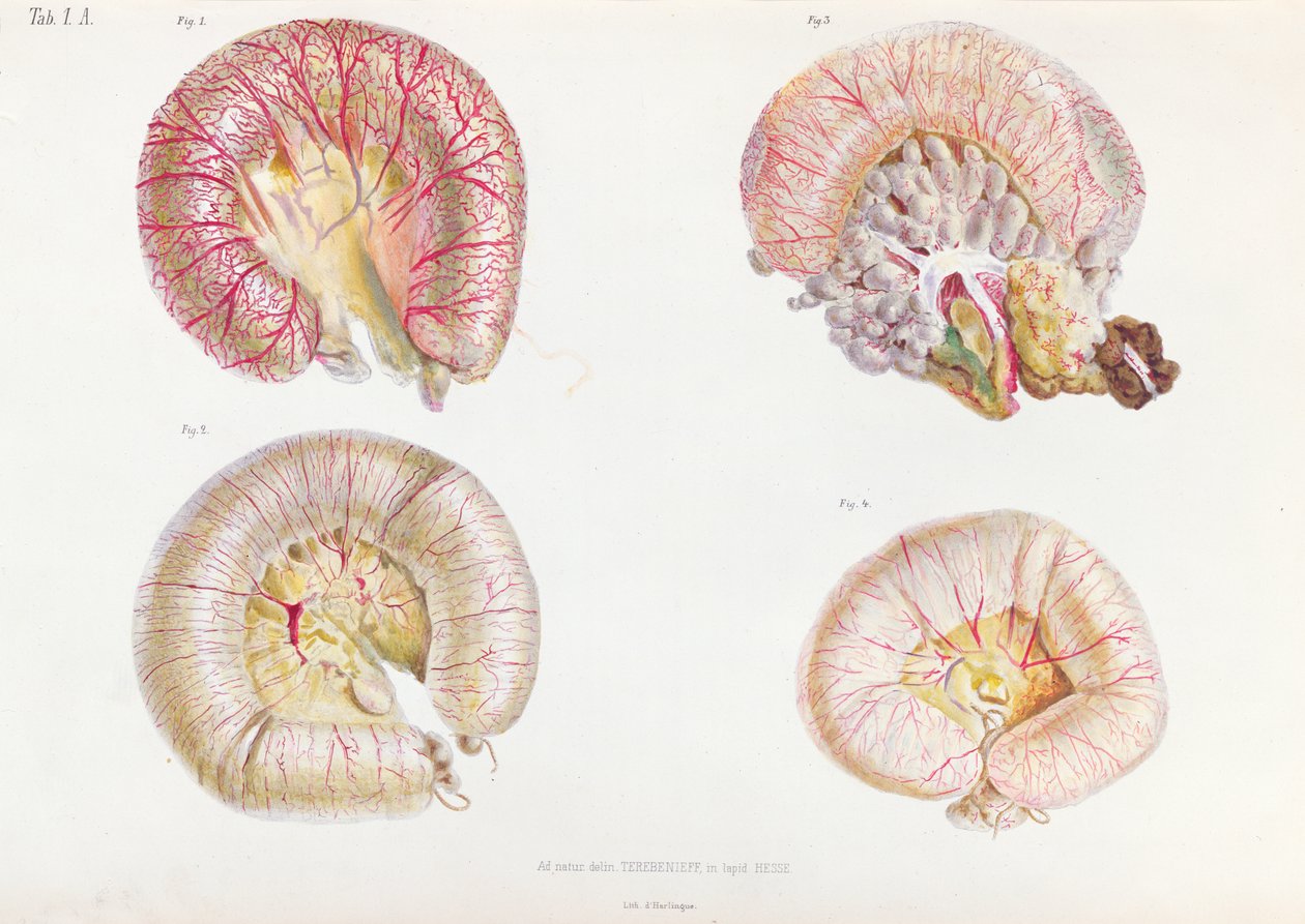 Koleratartunnan saaneiden suoliston ulkopinta, Anatomie Pathologique du Cholera Morbus, Nikolai Ivanovich Pirogov (1810-81), julkaistu Pietarissa, 1849 tekijältä Russian School