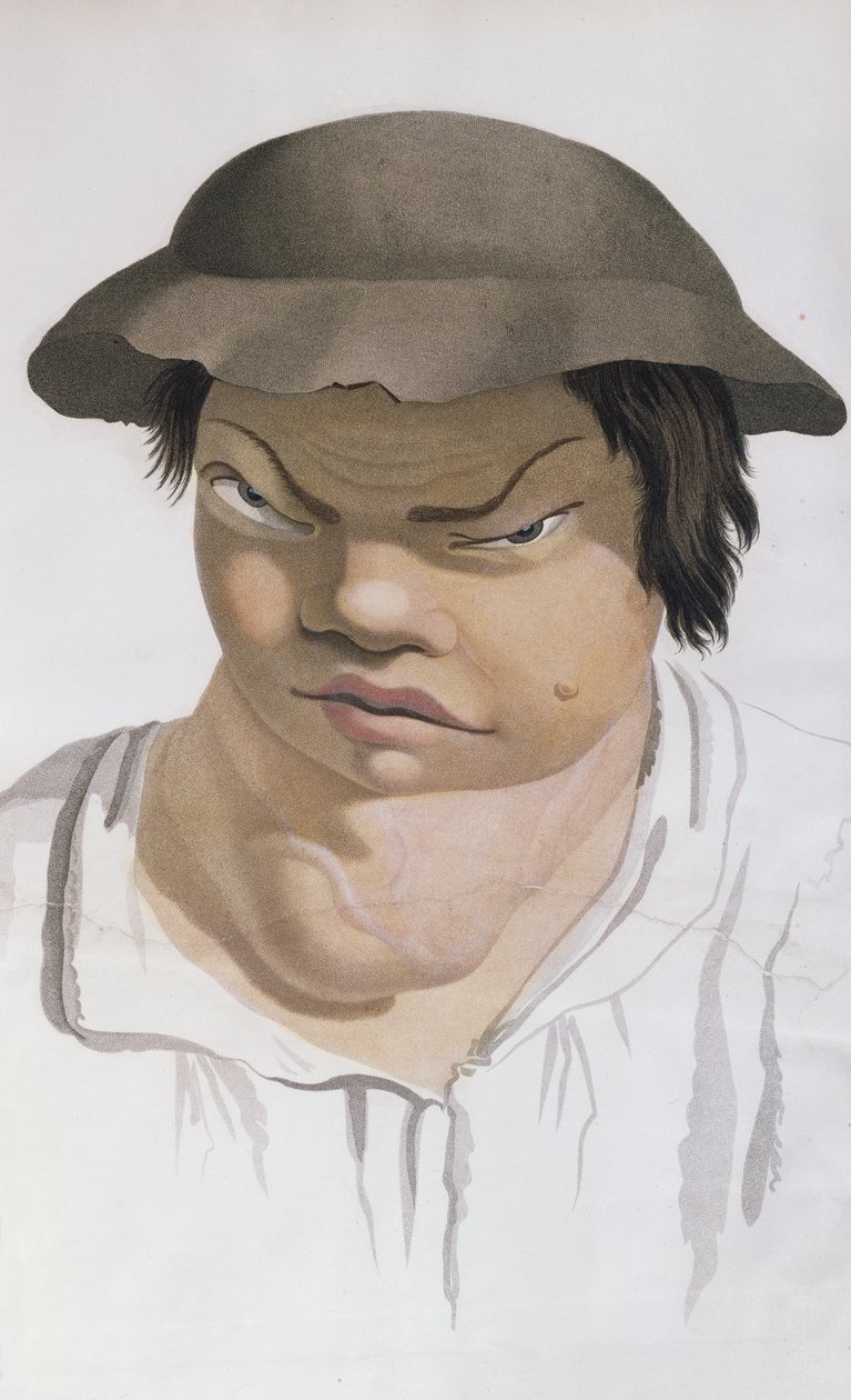 Endemic Scrofula, kuvitus paroni Jean Louis Alibertin (1768-1837) kirjasta. tekijältä Salvadore Tresca