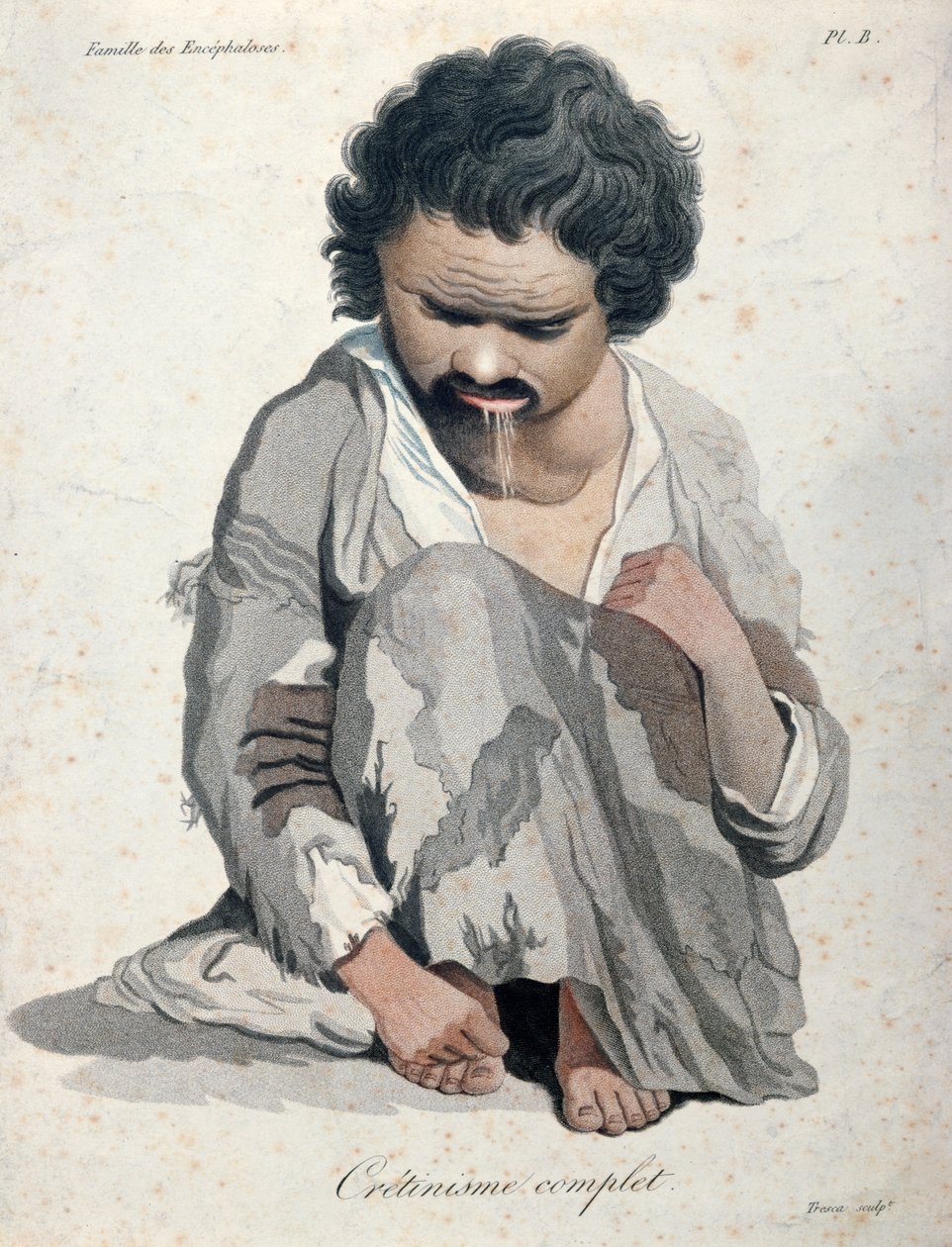 Totaalinen kretinismi, Baron Jean Louis Alibertin (1768-1837) kirjasta tekijältä Salvadore Tresca