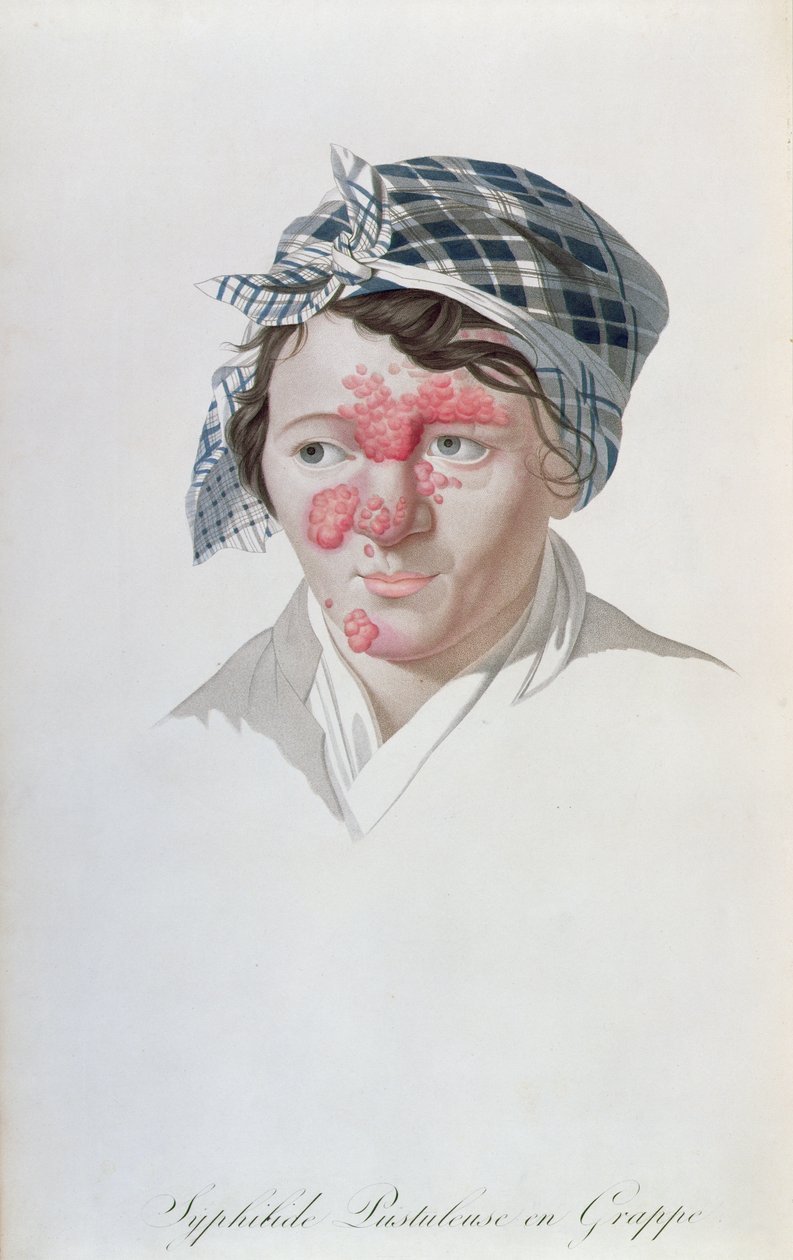 Syfiliset klusterin märkärakkulat, paroni Jean Louis Alibertin (1768-1837) kirjasta 1838 tekijältä Salvadore Tresca