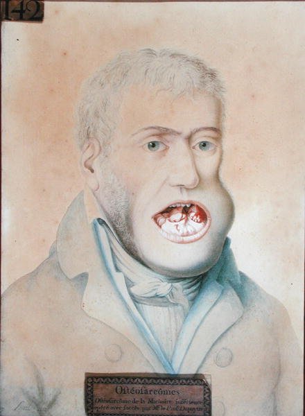 Alaleuan osteosarkooma, Guillaume Dupuytrenin (1777-1835) onnistuneesti leikattu (kynä paperilla) tekijältä School French