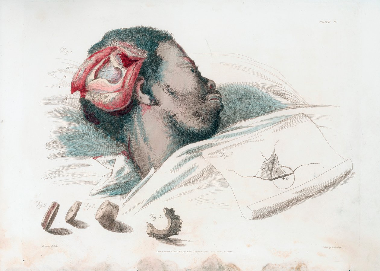 Näkymä kallon haavasta trefinaation ja särkyneen luukappaleen poistamisen jälkeen alhaalla vasemmalla, 1821 tekijältä Thomas Landseer
