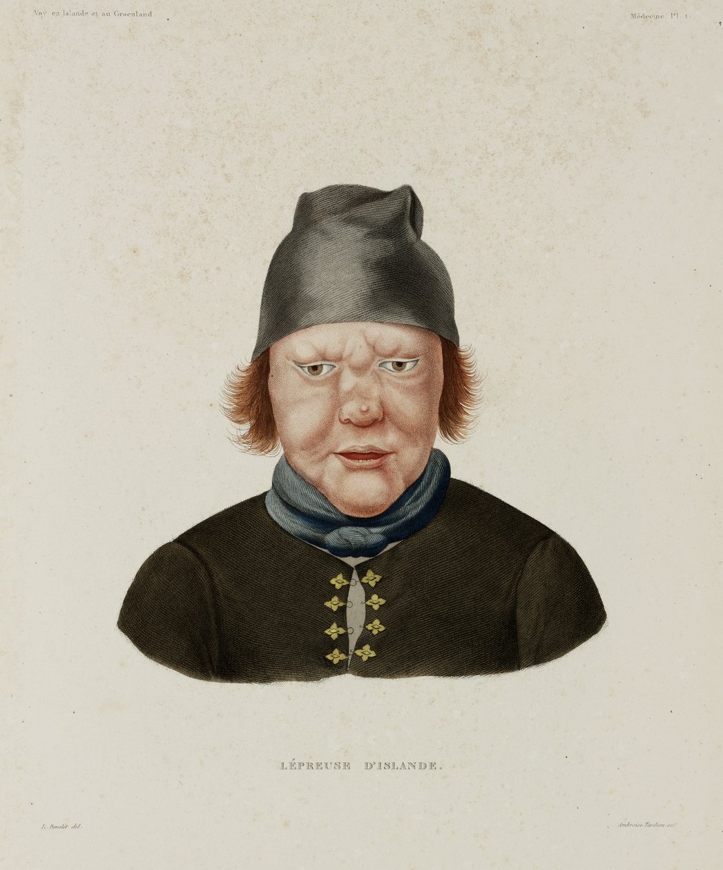 Sairaudet, Lepra Naaraspitaalinen, Islanti, 1800-luvun alku tekijältä Unbekannt