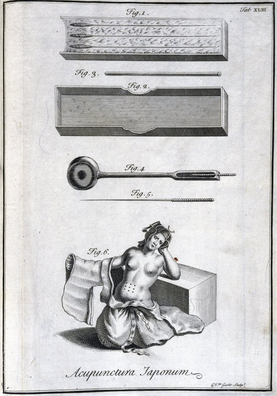 Vaihtoehtoinen lääketiede: akupunktioneuloja esittävä levy ja niiden käyttö, kaiverrus Engelbert Kaempferin (1651-1716) teoksesta "Japanin historia" (1727) (Akupunktioneulat ja niiden käyttö, n. 1690 G van der Guchtin kaiverrus kuva tekijältä Unbekannt