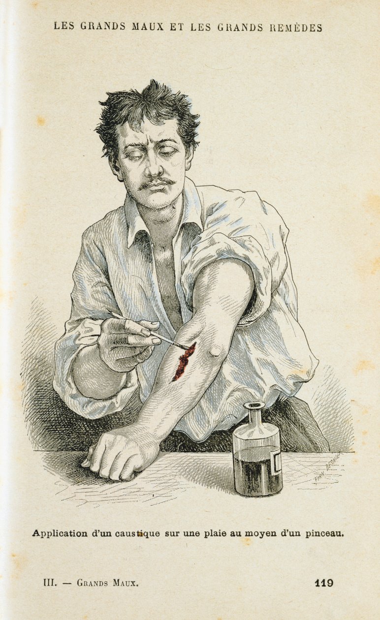 Haavan maalaus antiseptisellä liuoksella, c1890 tekijältä Unbekannt