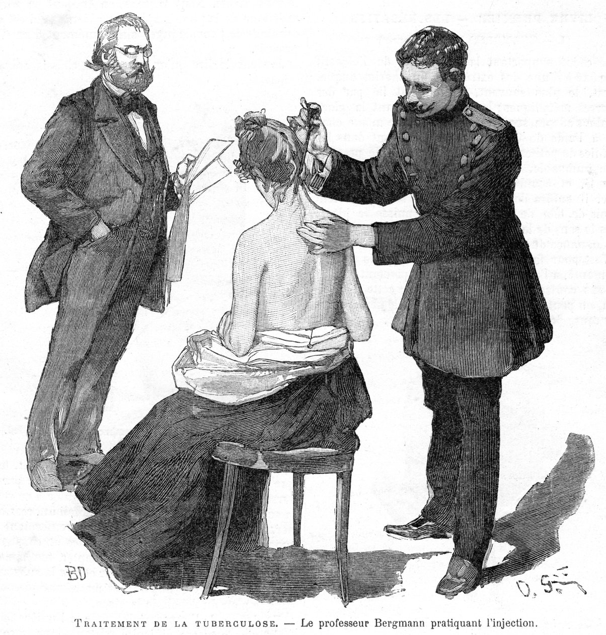 Professori Bergmann ruiskeena tuberkuloosipotilaalle, 1891 tekijältä Unbekannt