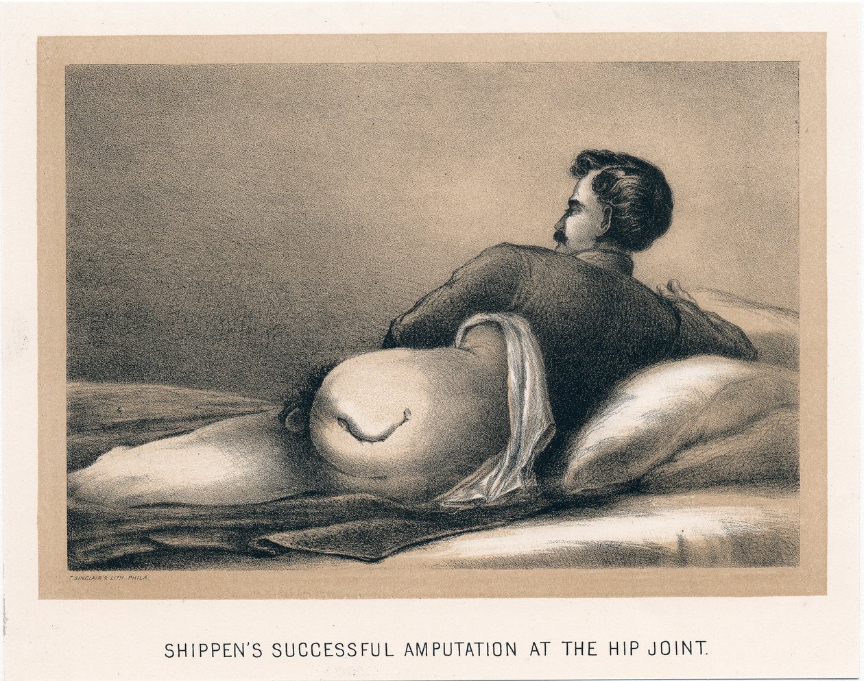 Shippens onnistui amputaatiossa lonkkanivelessä, Amerikan sisällissota, 1865 tekijältä Unbekannt