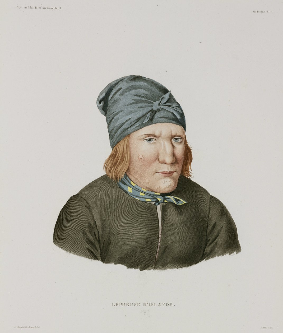 Sairaudet, Lepra Naaraspitaalinen, Islanti, 1800-luvun alku tekijältä Unbekannt