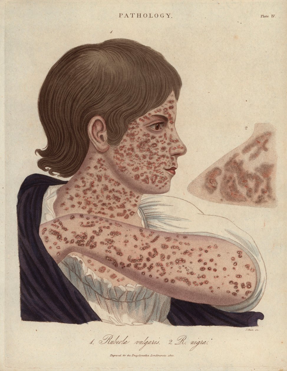 Measles and Rubeole - John Passin litografia, julkaistu John Wilkesin "Encyclopedia Londinensis" -teoksessa, painos J.Adlard, Lontoo. tekijältä Unbekannter Künstler