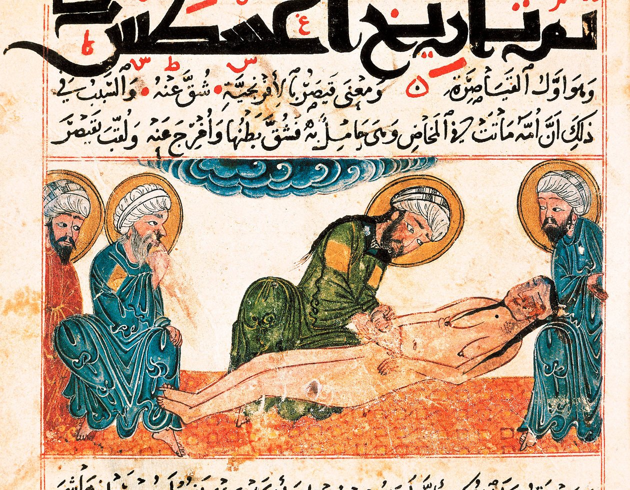 Keisarinleikkauksen esitys. Miniatyyri otettu Abu Raihan Al-Birunin (tai Alberunin) (973-1048), persialaisen intellektuellin ja tiedemiehen lääkekäsikirjoituksesta, folio 161. tekijältä Unbekannt