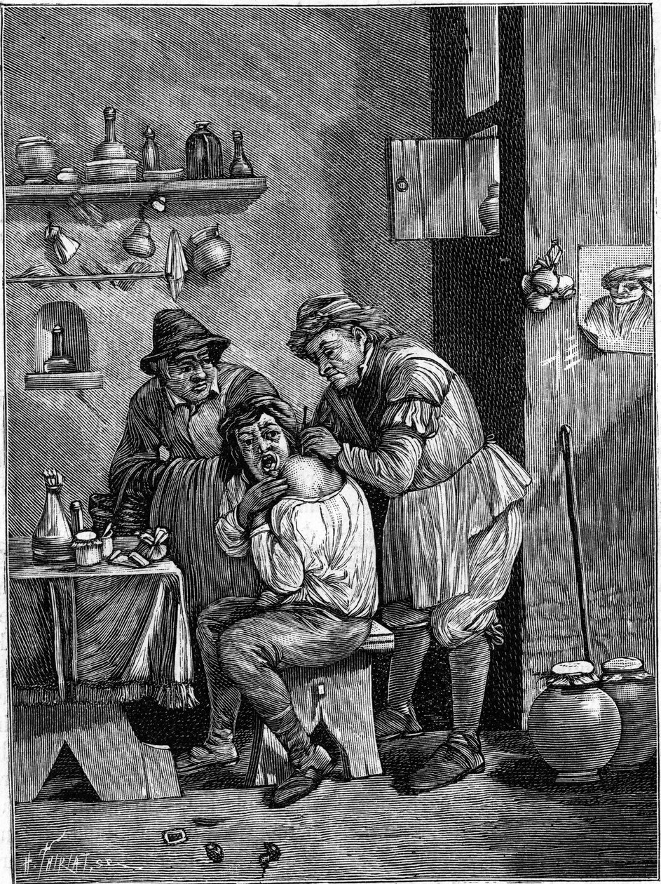 Karlataanikirurgi 1700-luvulla tutkimassa olkapäävammaa. (Ajan kaiverruksesta). Kaiverrus "" La Nature: revue des sciences et de leurs applications aux arts et a l